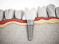 a render of a dental implant in Dallas