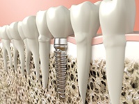 Digital illustration of a dental implant