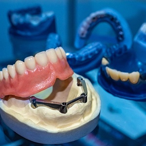 implant dentures in Dallas