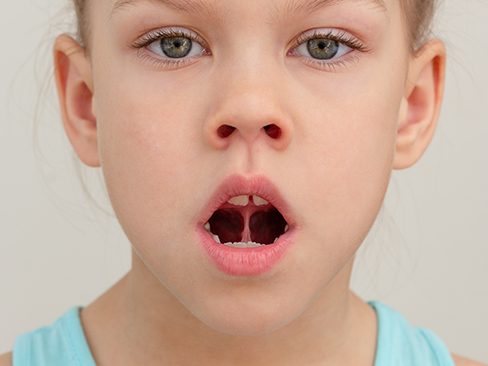 Young girl with a tongue-tie