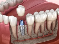 single dental implant in the lower jaw