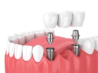implant bridge illustration for dental implants in Dallas