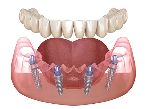 Diagram showing how implant dentures in Dallas work 