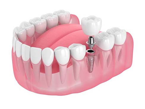 dental implant with a crown replacing a missing tooth