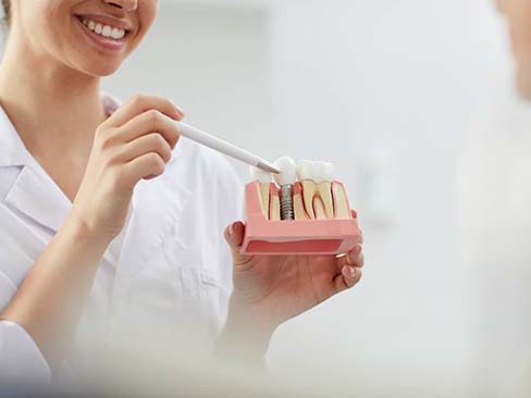 dental implant dentist in Dallas showing a patient a dental implant model