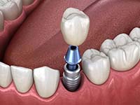 single dental implant with a crown