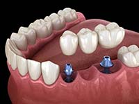 two dental implants with a dental bridge