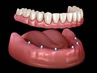 six dental implants securing a full denture