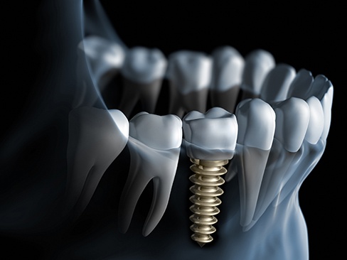 Animation of dental implant supported dental crown