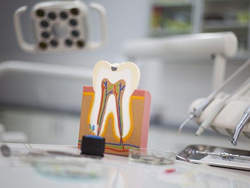 Model of the inside of a tooth before root canal therapy