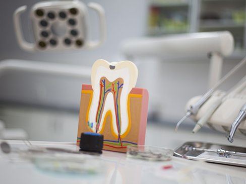 Model of the inside of a tooth before root canal therapy