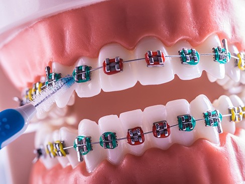 a close up of a model of a mouth with braces on it and an orthodontic flosser flossing them