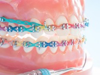 Colorful braces on model of teeth