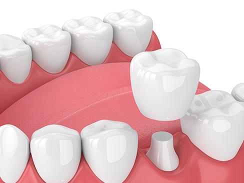 Animation of dental crown placement