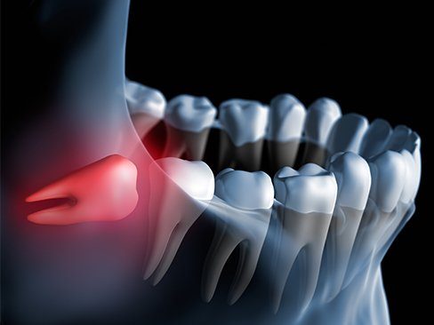 Animation of impacted wisdom tooth