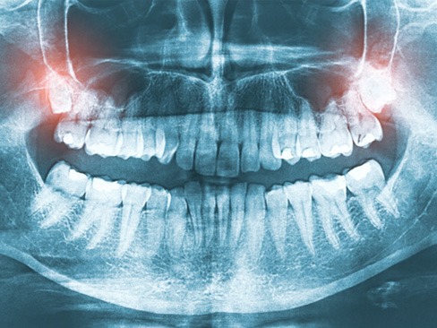 X-ray with wisdom teeth highlighted in red