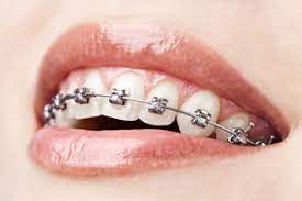 closeup of patient with braces smiling