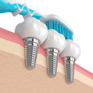 Model of toothbrush and dental implants
