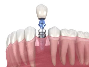Model of dental implant replacing lower tooth