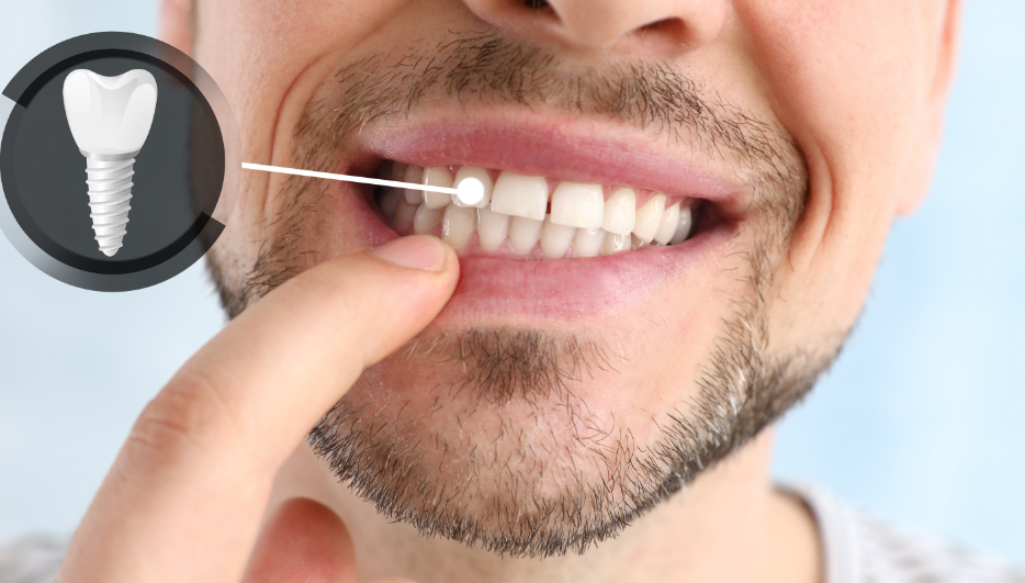 Man showing dental implant