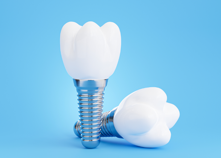 3D image of dental implants