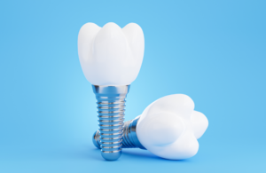 a model of a dental implant