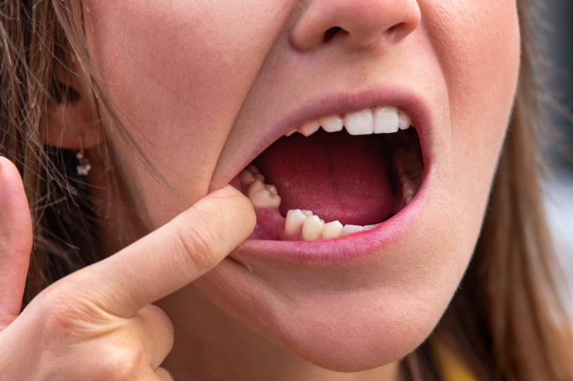 Girl pulling lip down to show missing tooth