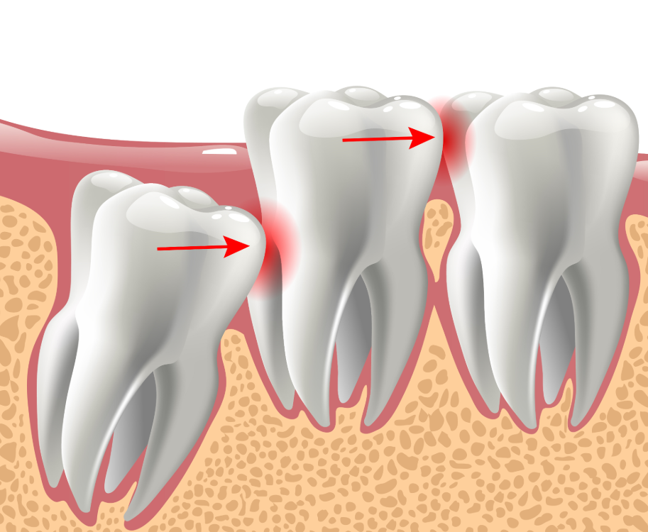 Illustrated cross section of wisdom teeth